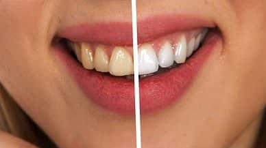 Does Teeth Whitening Damage Teeth?