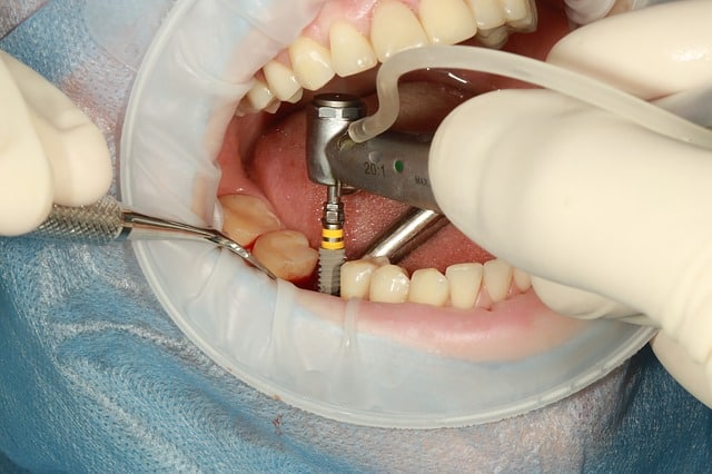 I don’t want to be toothless while having an implant. Is there a solution?