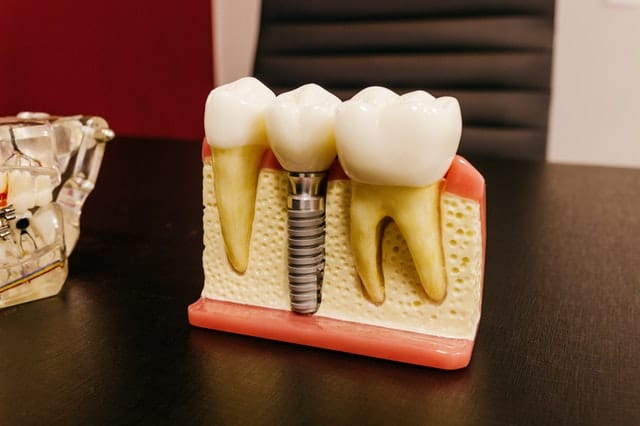 What is the All On Four Implant Technique?
