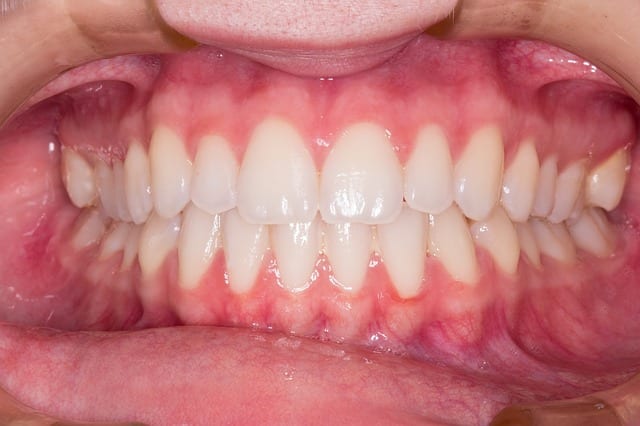 Are My Gums Bleeding Too Much? How Can I Be Treated?