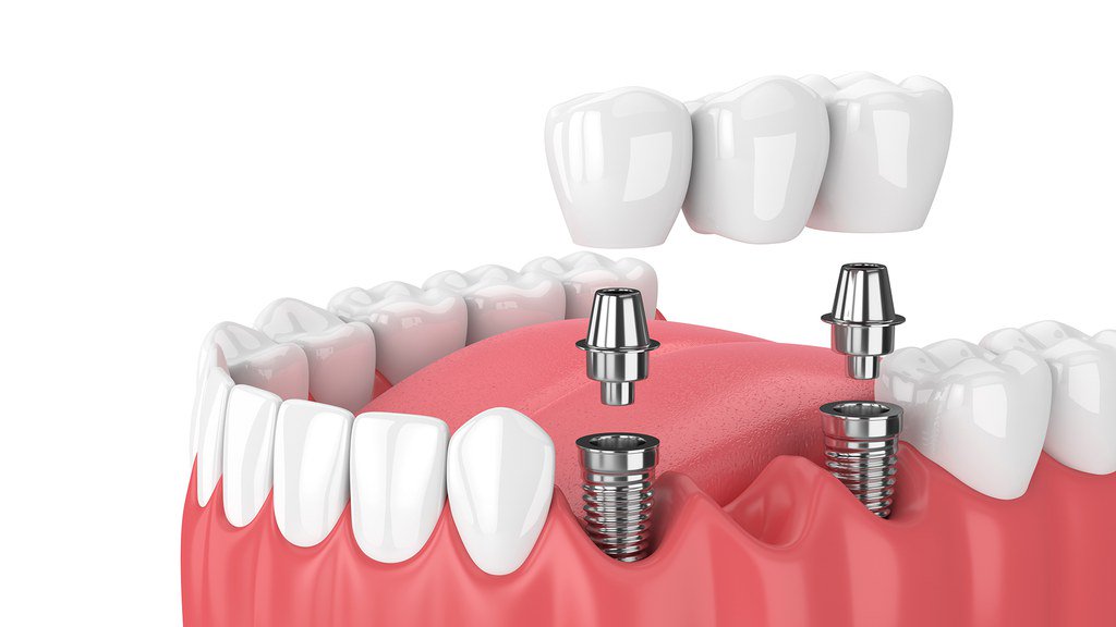 Ankara Dental Implant Treatment, Most Frequently Asked Questions About Bone Graft Applications For Ankara Implants, Curiosities