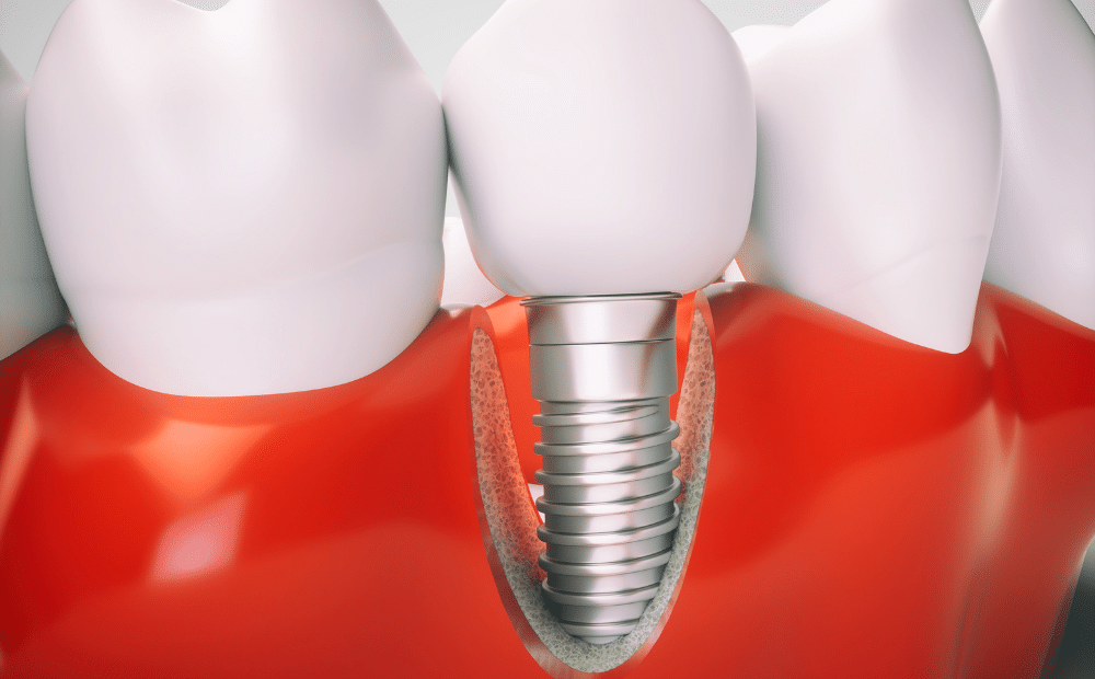 Can Implants Be Placed İn Thin Jawbones?