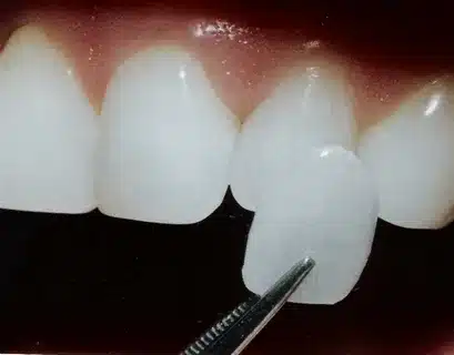 Diş Kaplamaları En Az On Yıl Dayanıklı Mıdır?