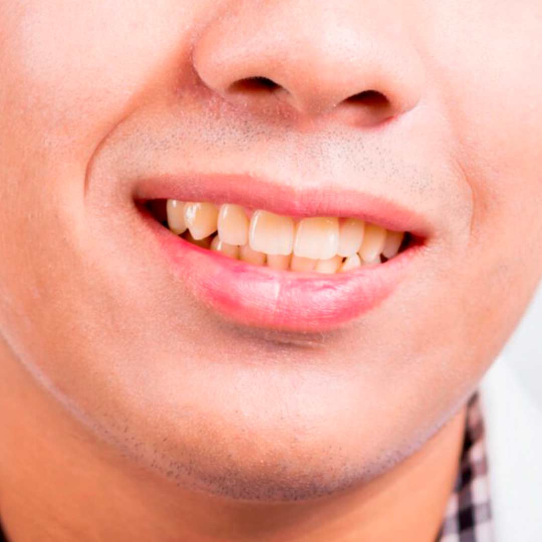 Dişlerimi Fırçalamama Rağmen Rengi Neden Sarı? Diş Beyazlatma Hakkında Bilgiler