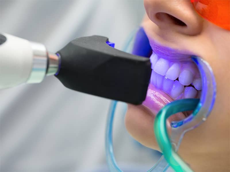 Diş Beyazlatma Yöntemlerinin Güvenilirliği: Ev mi, Klinik mi?
