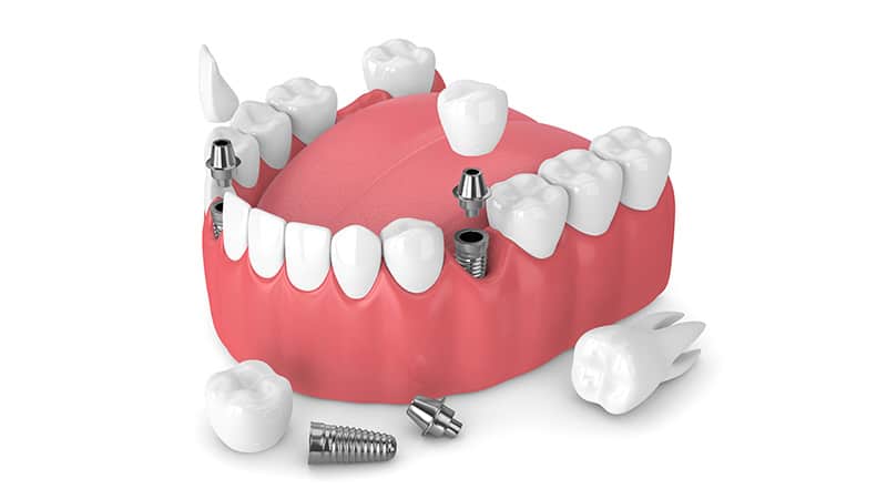 Aynı Gün İmplant Ankara