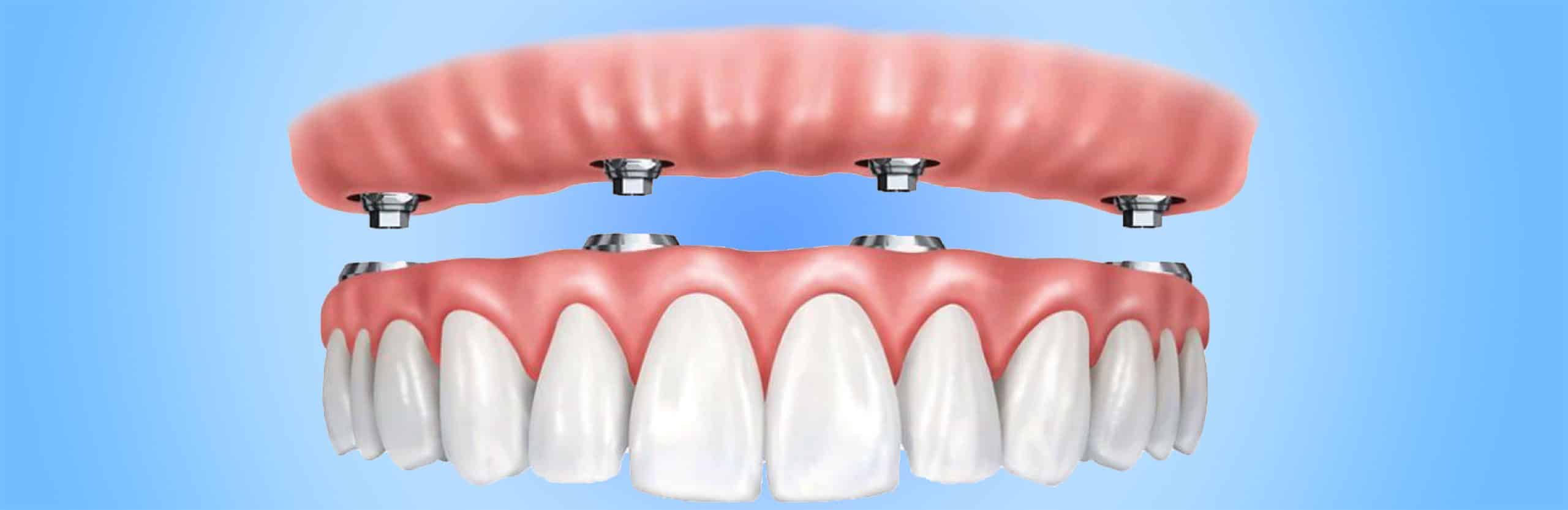 Tüm Ağız İmplant ve Protez Fiyatlandırması
